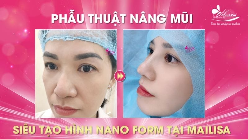 Địa chỉ nâng mũi uy tín tại Đà Nẵng