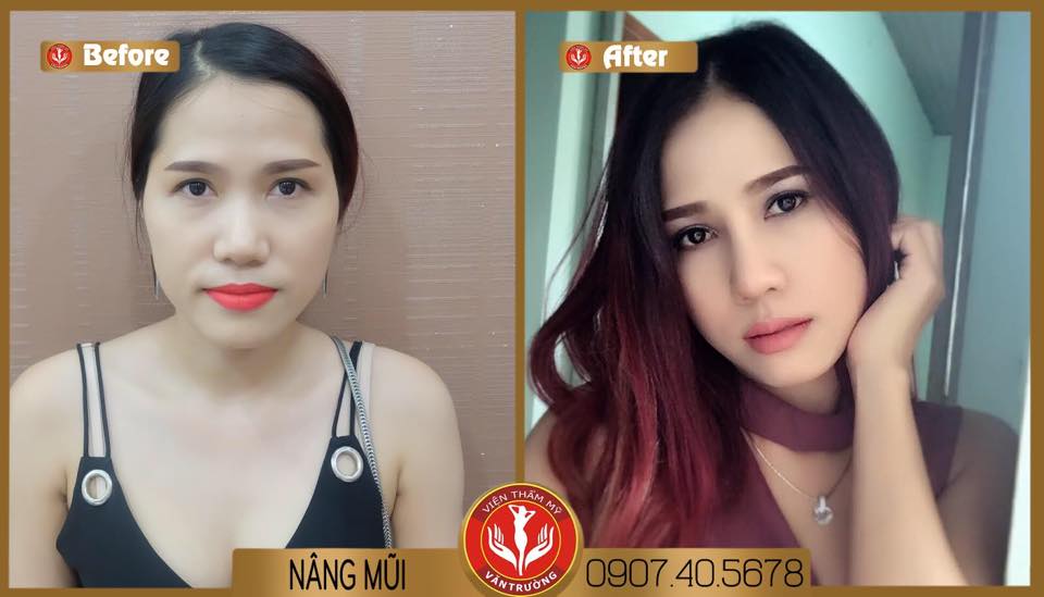 Địa chỉ nâng mũi uy tín tại Đà Nẵng